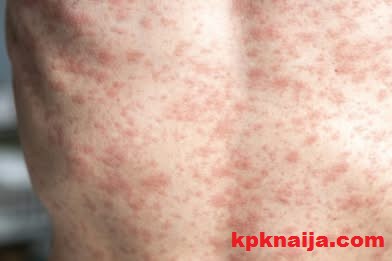NCDC Measles Update: What You Need to Know as Confirmed Cases Hit 19,213 in Nigeria